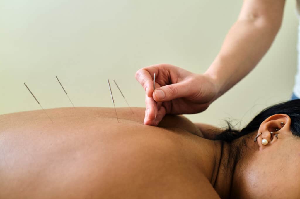 Bei der Akupunktur geht es darum, Blockaden im Körperenergiekreislauf zu lösen und den Körper wieder ins Gleichgewicht zu bringen.